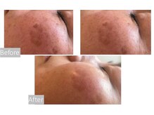 リラクゼーションサロン アイリス(IRIS)/光フェイシャル