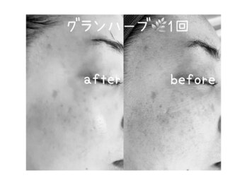 エステ ド あーと/ before/after