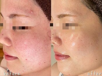 エヌエースキン 北谷店(NAskin)/ハーブピーリング｜美白ケア