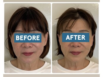 ル メルシェ(Lemerci)/小顔矯正でスッキリ！！