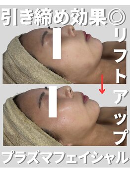 アディス 心斎橋(ADISE)/限界濃度IPS導入プラズマ美肌