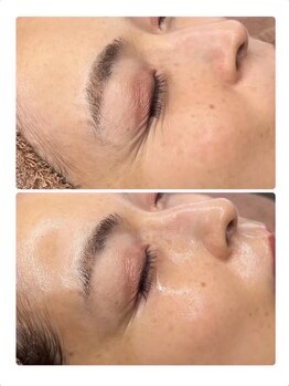 ホワイトアクア 京都店(WHITE AQUA)/ララピール/毛穴/京都