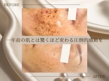 サロン ド ビューティージュエル(salon de beauty JEWEL)の雰囲気(【ぽろっとはがれるシミケア】本気にシミケアをしたい方必見!)