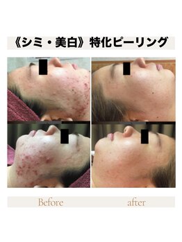 カナウ produced by きょうわ整体院(Kanau.)/《シミ・美白》特化ピーリング