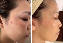 ラシェプリズ(LACHER PRISE)