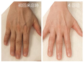 キレイテ 福岡天神店/40代/4回目【天神ハンドケア】