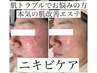 ずっと肌トラブルでお悩みの方へ！本気のニキビケア肌改善エステ