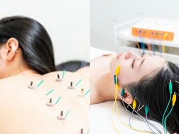 アキュセル ヨウコナース アンド 暢子美容鍼灸(Accu:Cell Youko nurse)の写真/【女性鍼灸師/特許取得の美容鍼灸】お顔と身体を一緒にケアするからすっきり小顔が長く続く美容鍼。