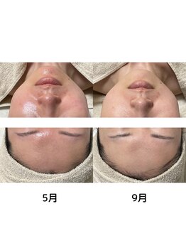 ルアラナ(Lualana)/4ヶ月のお肌変化