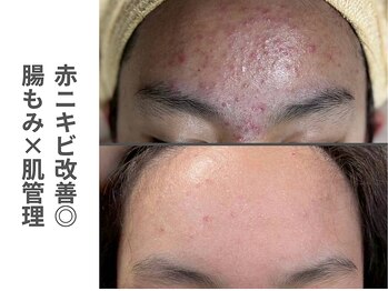 ソルレ 宮崎店(SOLURe)/ニキビ改善◎腸もみ×肌管理