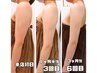 【女性】気になる二の腕にMAX照射！