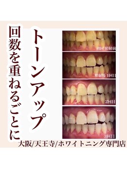 アクア 天王寺店(AQUA)/セルフホワイトニング/天王寺