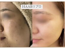 アールズ スリム(R's slim)/医療提携★ハーブピーリング