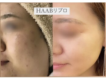 アールズ スリム(R's slim)/医療提携★ハーブピーリング