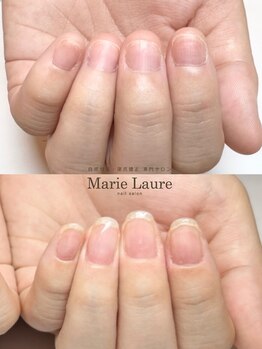 マリーロール 梅田店(Marie Laure)/自爪育成/深爪矯正/ネイルケア