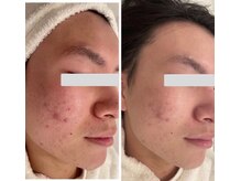 ジェニックサロン グランドギンザ ひたちなか(GENIC SALON GRAND GINZA)/毛穴・赤みすっきり