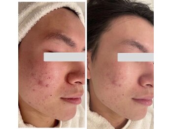 ジェニックサロン グランドギンザ ひたちなか(GENIC SALON GRAND GINZA)/毛穴・赤みすっきり