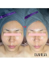 ダリア(Dahlia)/ハーブピーリング