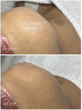 スパークル/毛穴/脱毛/ワックス/毛穴洗浄