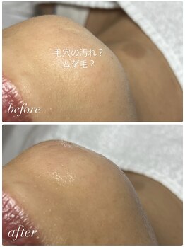 スパークル/毛穴/脱毛/ワックス/毛穴洗浄