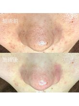 エクラ バイ シャンリィ(eclat by shanLy)/毛穴エクストラクション