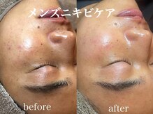 ネオリー(neorii)/毛穴洗浄＋ハーブピーリング