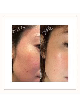 ザ シティ 札幌店(The CITY)/ハーブピーリングでニキビケア♪