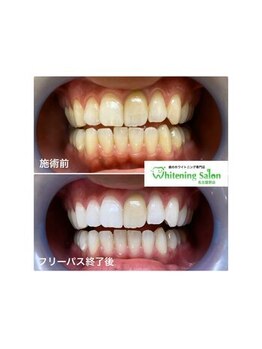 ホワイトニングサロン 名古屋駅店/【ホワイトニング施術例】