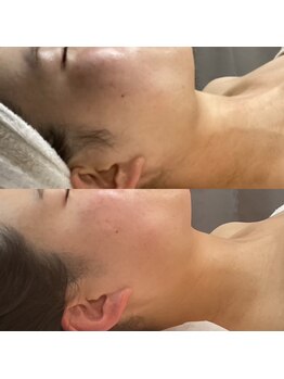 ウィンウィン 新山口店(Win Win)/フェイスライン、首すっきり