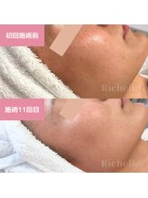 リシェル(Richelle)/ 【GREENPEELメラウェーブ】