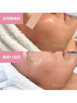 リシェル(Richelle)/ 【GREENPEELメラウェーブ】