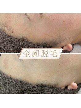 カルディエ(Cardie)/もみあげ脱毛　ビフォーアフター