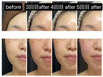 ジュエル シズオカ(JEWEL Shizuoka)/セルラムBefore After５回