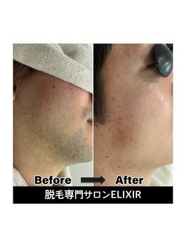 エリクサー 太田店(Elixir)/before after