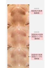 クレヴィー(Creviy)/韓国式3D毛穴洗浄＆REVlハーブ