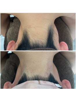 ミース 北九州店/うなじ●ビフォーアフター