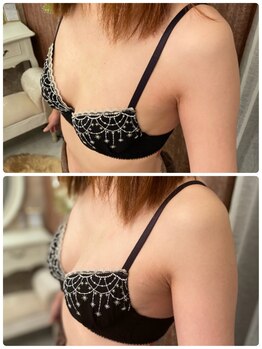 スマイルクルー(SmileClue)/初回ビフォーアフター症例