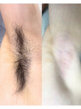 シルビー(CILBE)/脇ミックス脱毛