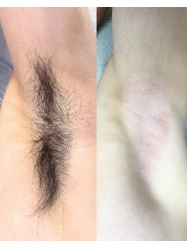 シルビー(CILBE)/脇ミックス脱毛