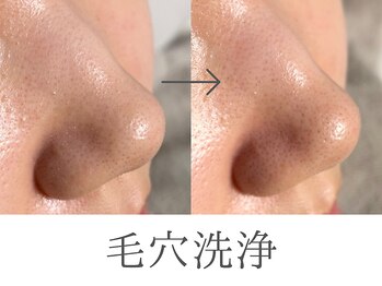 レイミー(reimee)/【毛穴洗浄】Before/After