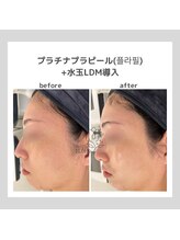 韓国肌管理室pom.haneul【ポムハヌル】LDM/インモード/ララピール/プラピール福岡天神/韓国肌管理室