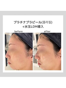 韓国肌管理室pom.haneul【ポムハヌル】LDM/インモード/ララピール/プラピール福岡天神/韓国肌管理室