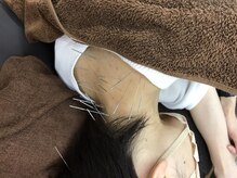はり処せと/ストレートネックや猫背への施術