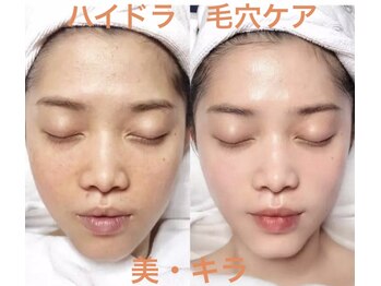 美 キラ/ハイドラ毛穴ケア