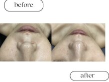 ルボン(RUBON)/鼻WAX＋ピーリング＋毛穴洗浄