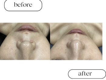 ルボン(RUBON)/鼻WAX＋ピーリング＋毛穴洗浄