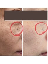 クオーレ(cuore)/シミケアビフォーアフター