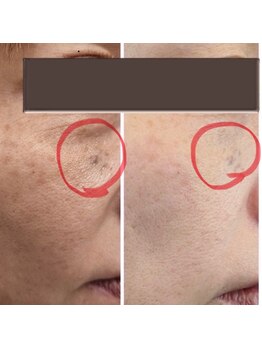 クオーレ(cuore)/シミケアビフォーアフター