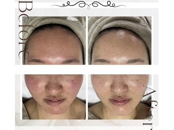 ピュアル 川口(Pual)/【ニキビ/赤み/肌荒れ】Pual症例