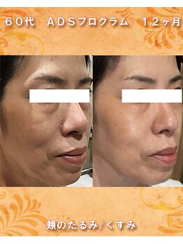 ナイア(naia)/リセラADS使用症例